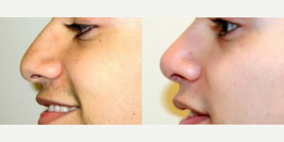 Rhinoplasty before and after photo