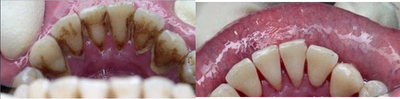 Teeth Whitening before and after photo