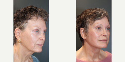 Facelift before and after photo