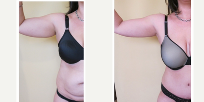 Liposculpture before and after photo