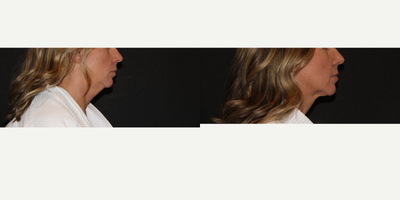 Liposuction before and after photo