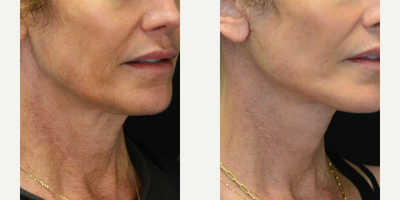 Mini Facelift before and after photo