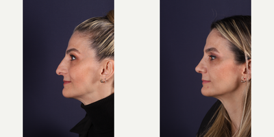 Revision Rhinoplasty before and after photo