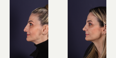 Revision Rhinoplasty before and after photo