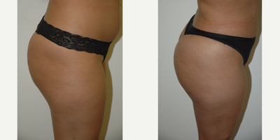 Brazilian Butt Lift before and after photo