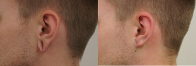 Earlobe Repair before and after photo