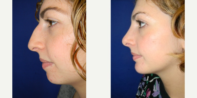 Rhinoplasty before and after photo