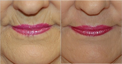 Laser Peel before and after photo