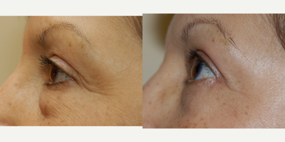 Eyelid Surgery before and after photo