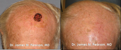 Facial Reconstructive Surgery before and after photo
