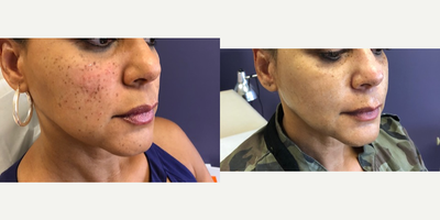 Mole Removal before and after photo