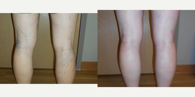 Sclerotherapy before and after photo