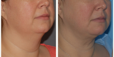 Chin Liposuction before and after photo