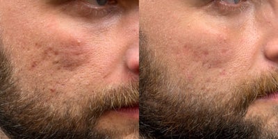 Coolaser before and after photo