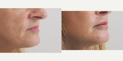 Facial Fat Transfer before and after photo