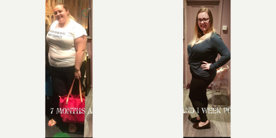 Gastric Bypass before and after photo