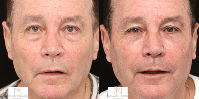 Juvederm before and after photo
