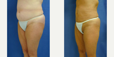 Liposuction before and after photo