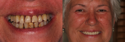 Dental Implants before and after photo