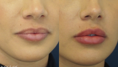 Dermal Fillers before and after photo