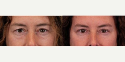 Eyelid Surgery before and after photo