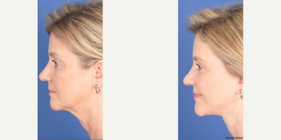Facelift before and after photo