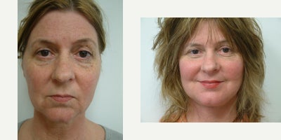 Facelift before and after photo