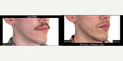 Restylane before and after photo