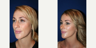 Rhinoplasty before and after photo