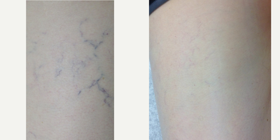Sclerotherapy before and after photo