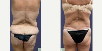 Tummy Tuck before and after photo