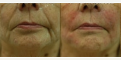 Botox before and after photo