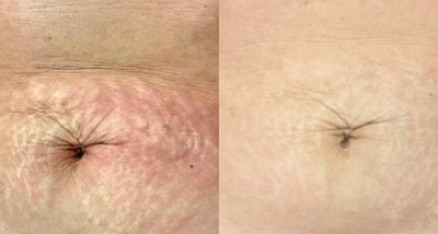 Fractional Laser before and after photo