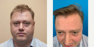 FUE Hair Transplant before and after photo