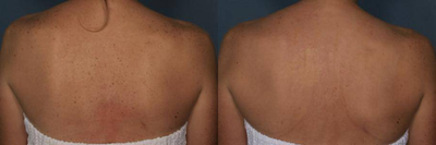 IPL before and after photo