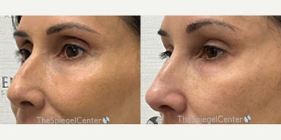 Nonsurgical Nose Job before and after photo