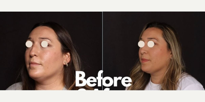 Rhinoplasty before and after photo