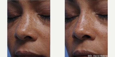 African American Rhinoplasty before and after photo