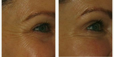 Botox before and after photo