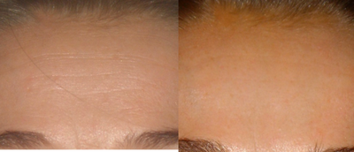 Botox before and after photo