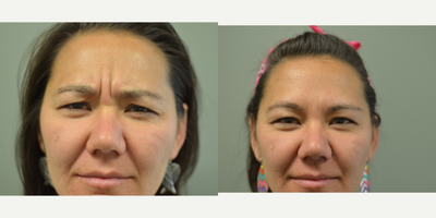 Botox before and after photo