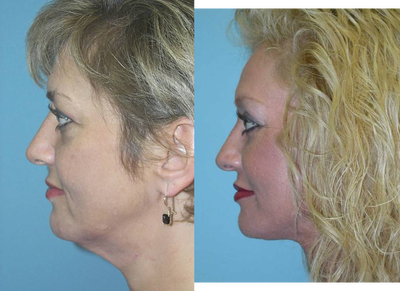 Brow Lift before and after photo