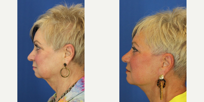 Facelift before and after photo