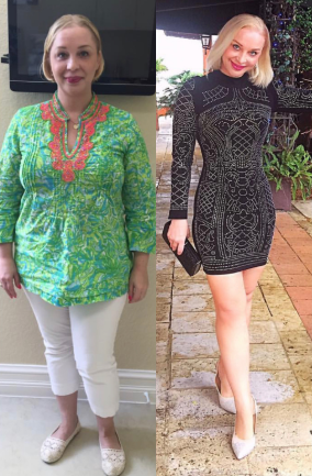 Gastric Balloon before and after photo