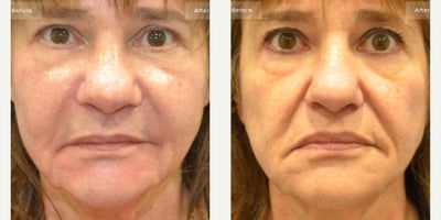 Rhinoplasty before and after photo