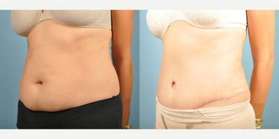 Tummy Tuck before and after photo