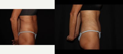 Tummy Tuck before and after photo