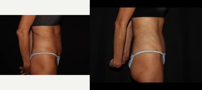 Tummy Tuck before and after photo