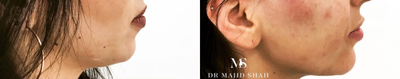 Dermal Fillers before and after photo
