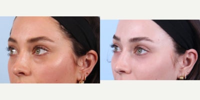 Eyelid Surgery before and after photo